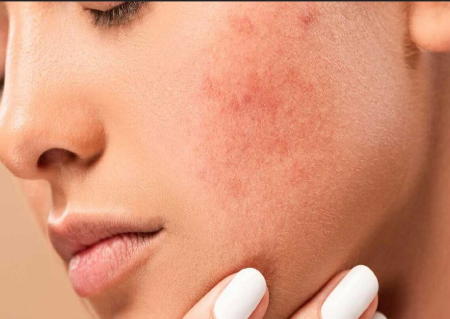 Sivilce Bakımı ve Tedavisi