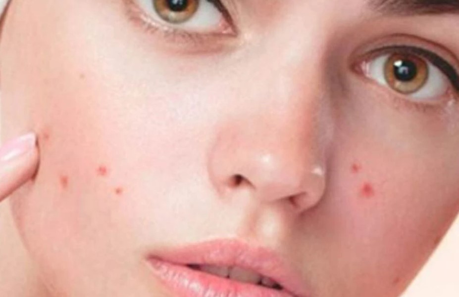 Akne ve Sivilce Tedavisi