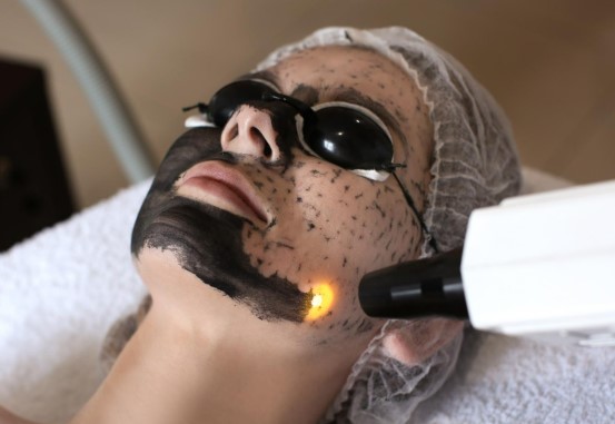 Karbon Peeling Uygulaması